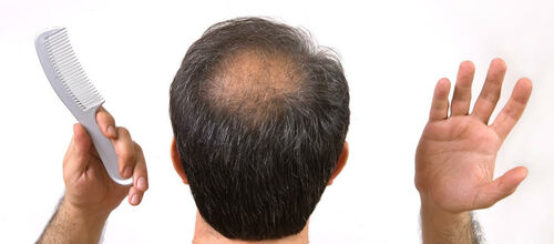 Hajhullás kezelése - hajszeszek, mezoterápia
