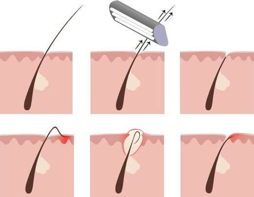 borotválkozás - irritáció - gyulladás 