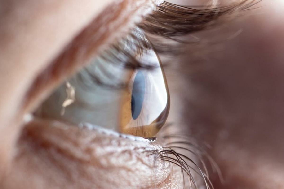 A keratoconus és hatása a mindennapi életre: útmutató a szaruhártya egészségéhez