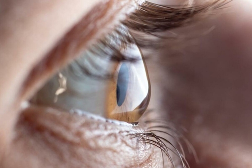A keratoconus és hatása a mindennapi életre: útmutató a szaruhártya egészségéhez